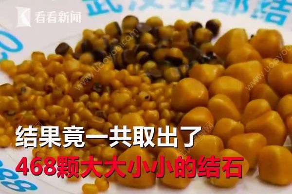 爱吃油炸长468颗结石，油炸食品的危害有哪些？(1)