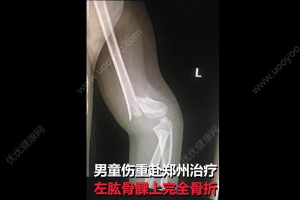 男童被踹下滑梯胳膊折成三截，肇事方家长抱娃就溜(2)