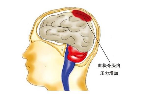 脑溢血患者家属质疑被过期药加重病情，医院:只用了一瓶(4)