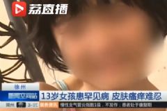 女孩患罕见病最怕热，家贫买不起空调只靠奶奶背起来回走[多图]