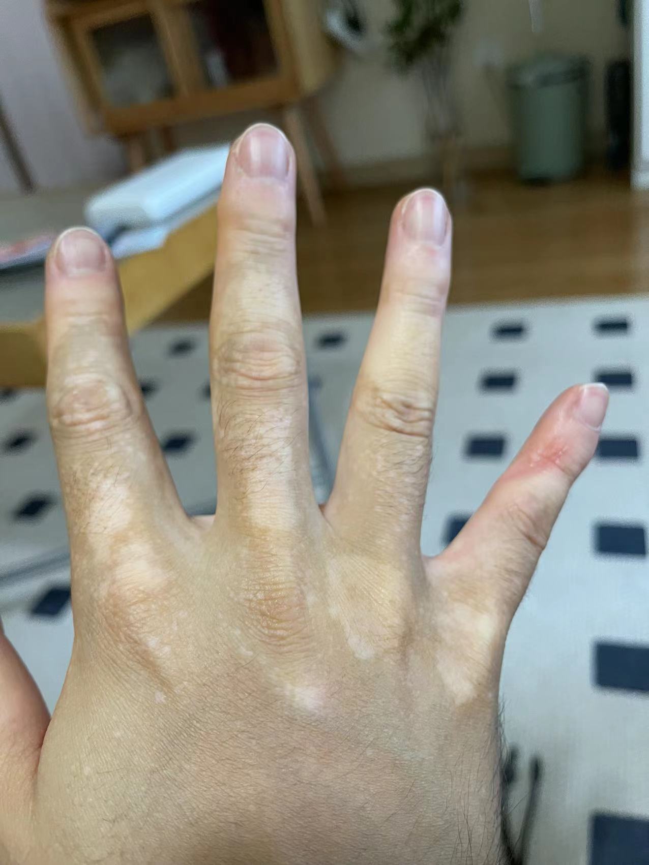 希格玛SQLED308白癜风光疗仪科普：白癜风要怎么治疗会好呢?	